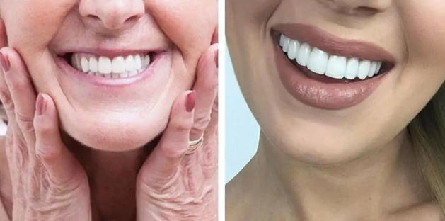 Carillas Dentales Snapon Smile