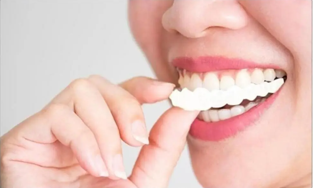 Carillas Dentales Snapon Smile